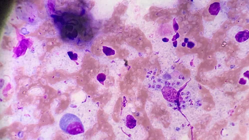 Microscopía de tejido hepático con esteatosis